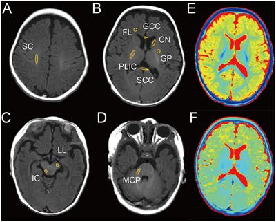 The value of synthetic MRI in detecting the brain changes and hearing impairment of children with sensorineural hearing loss